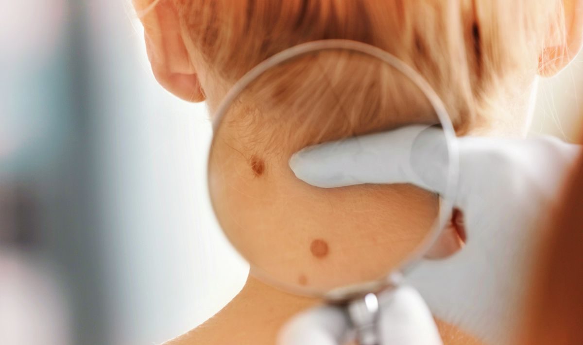 anyajegy, melanóma, anyajegyszűrés