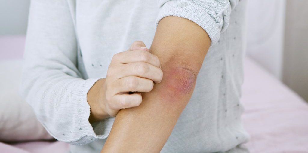 pikkelysömör, bőrgyógyász, tél