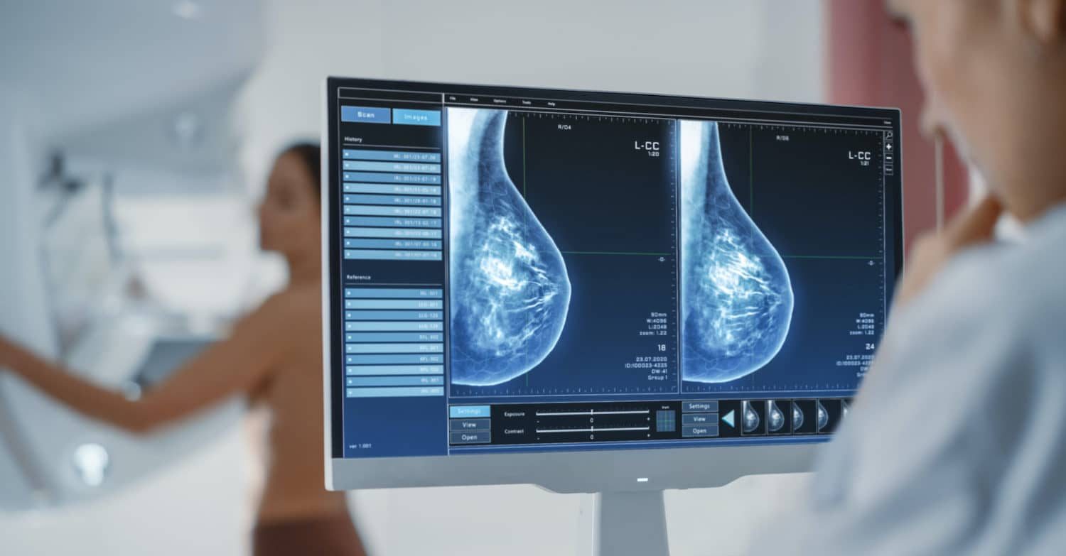 mammográfia, mellrák, szűrővizsgálat