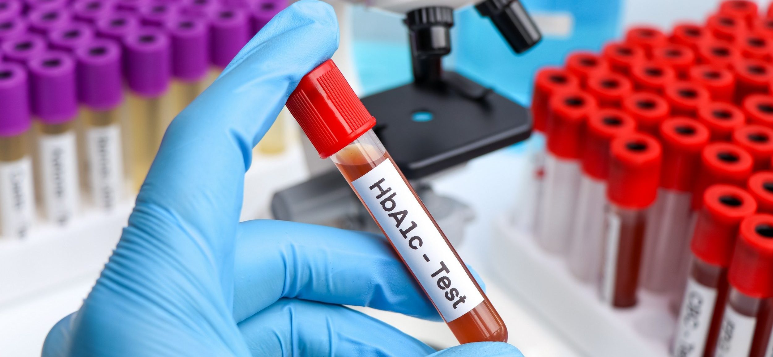 diabetológia, HbA1c, diagnózis