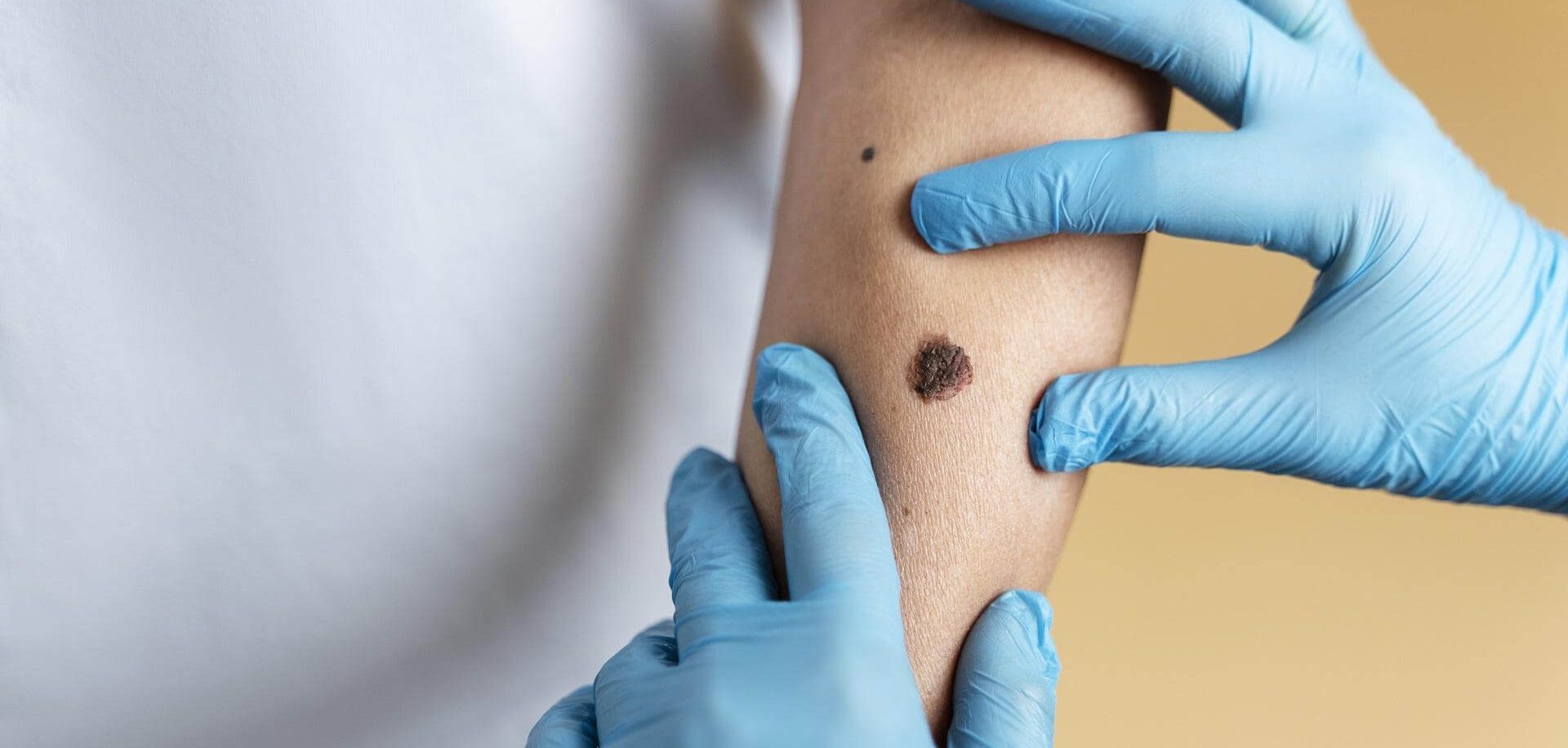 sebészet, anyajegyszűrés, egészség